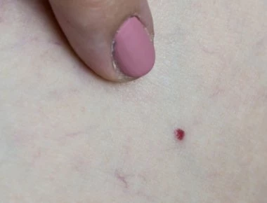 Κόκκινες ελιές στο δέρμα: Μην τις αγνοείτε- Τι μπορεί να σημαίνουν